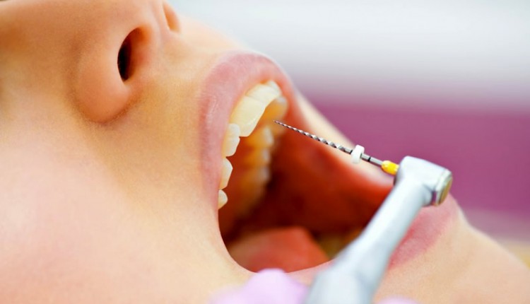 endodoncia