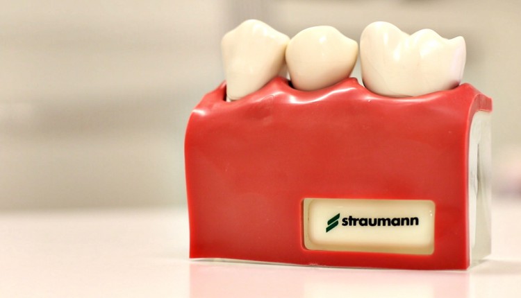 implantes dentales salamanca